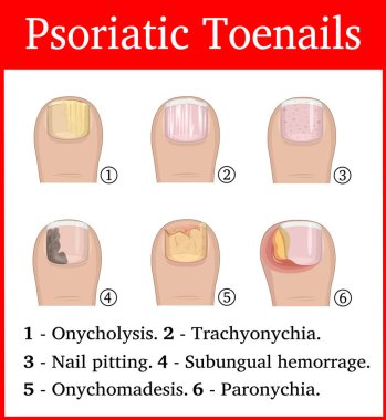 Illustration of Psoriatic toenails clipart