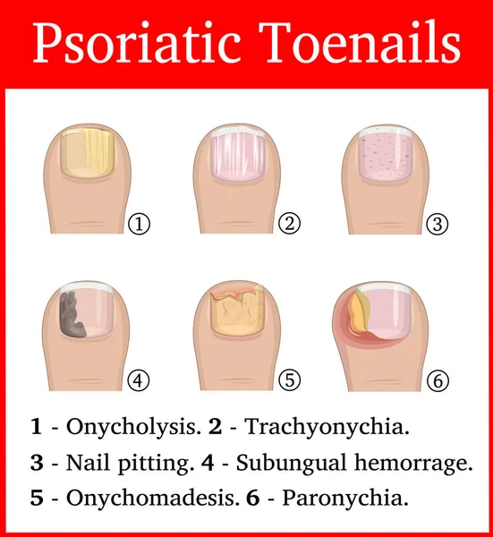 Ilustração das unhas dos pés Psoriatic — Vetor de Stock