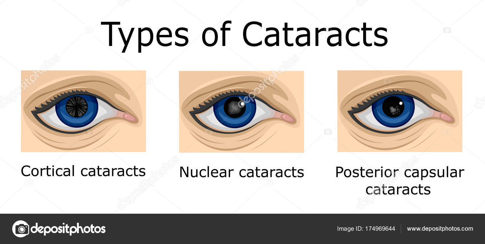 Illustration Three Types Cataracts Cortical Nuclear Posterior Capsular