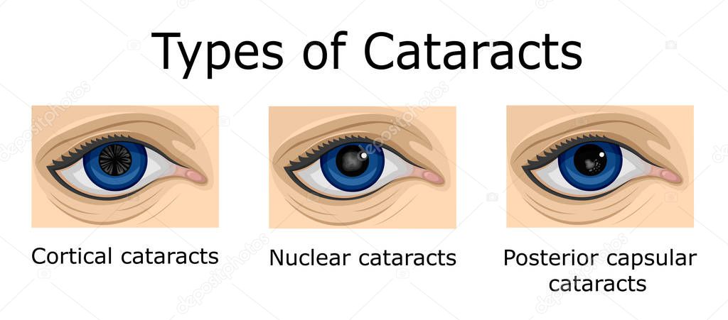 Illustration of three types of cataracts, such as cortical, nuclear and posterior capsular cataracts