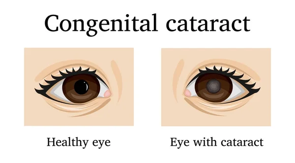 Illustration Congenital Cataract Infant — Stock Vector