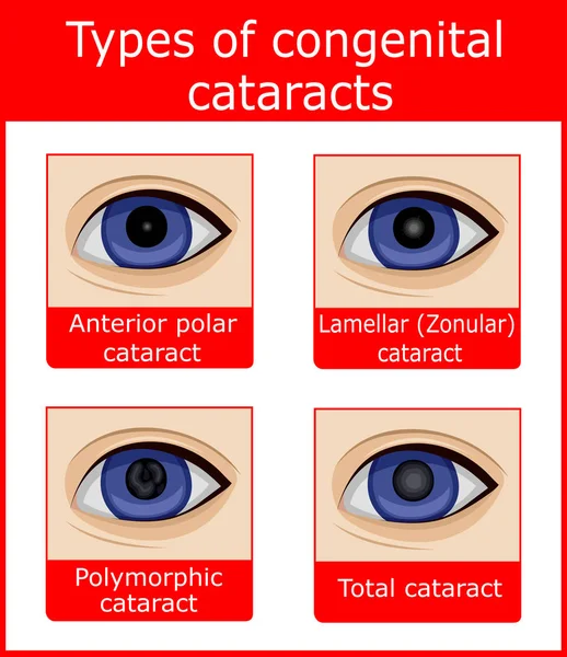 Four Types Congenital Cataracts Anterior Polar Lamellar Polymorphic Total — Stock Vector