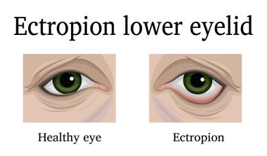 Illustration Ectropion of the lower eyelid. For comparison, a healthy and sore eye is depicted clipart