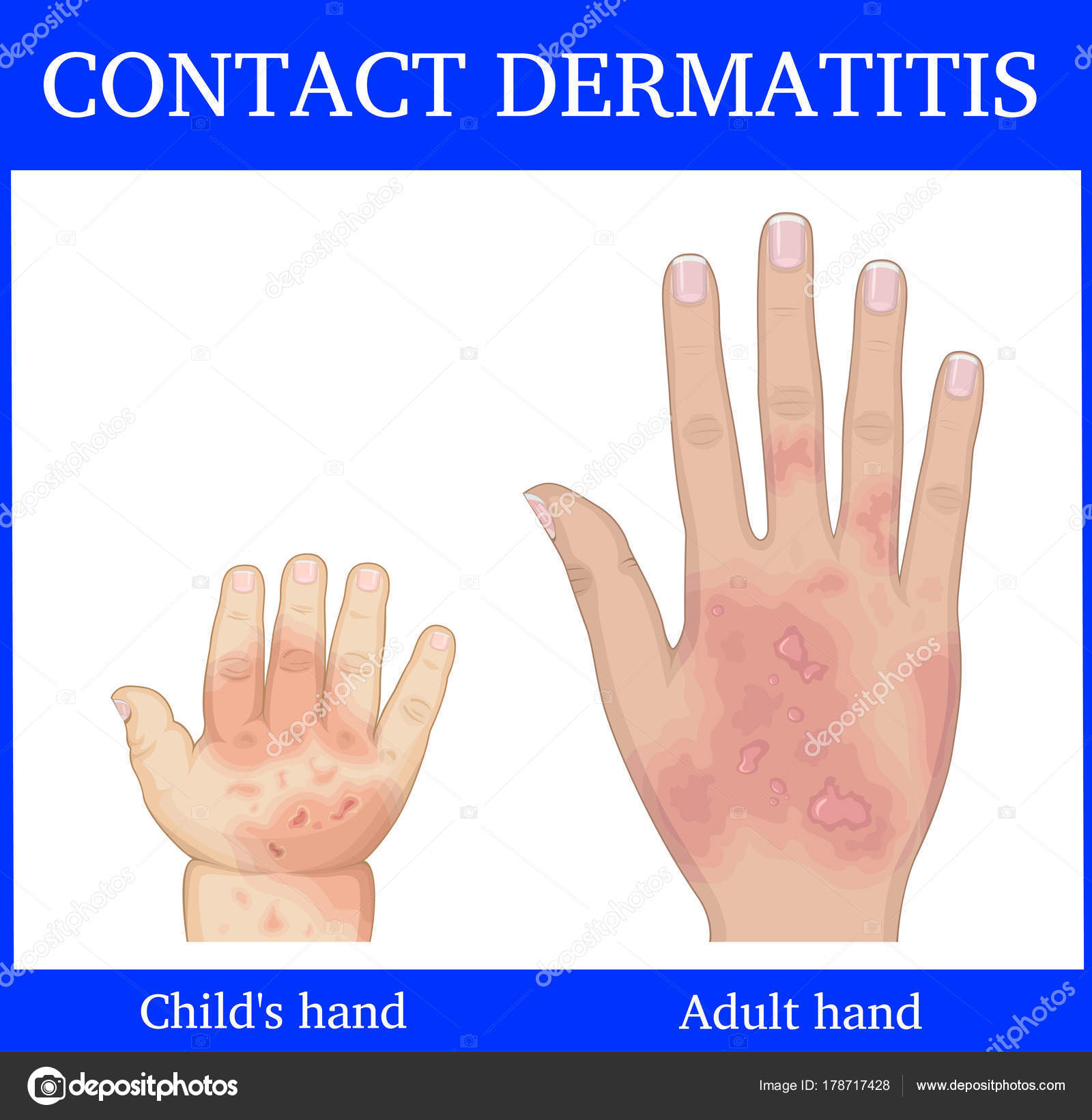 Dermatit ile temas. Tedavisi Dermatit ile temas. Tedavisi