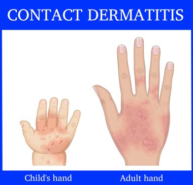  Yetişkin ve çocuk bir yandan illüstrasyon Kontakt Dermatit