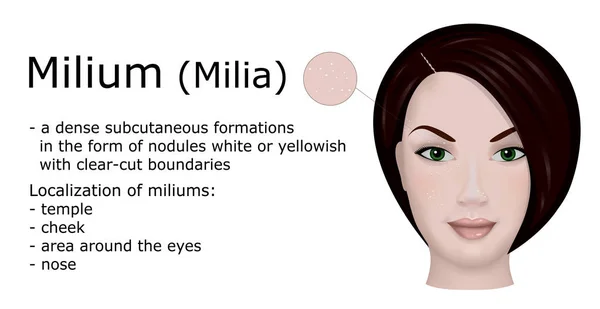 Иллюстрация Дерматологического Заболевания Милиум Например Лицо Молодой Женщины Симптомами Этого — стоковый вектор