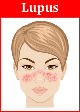 Genç bir kızın yüzünde sistemik lupus illüstrasyon belirtileri