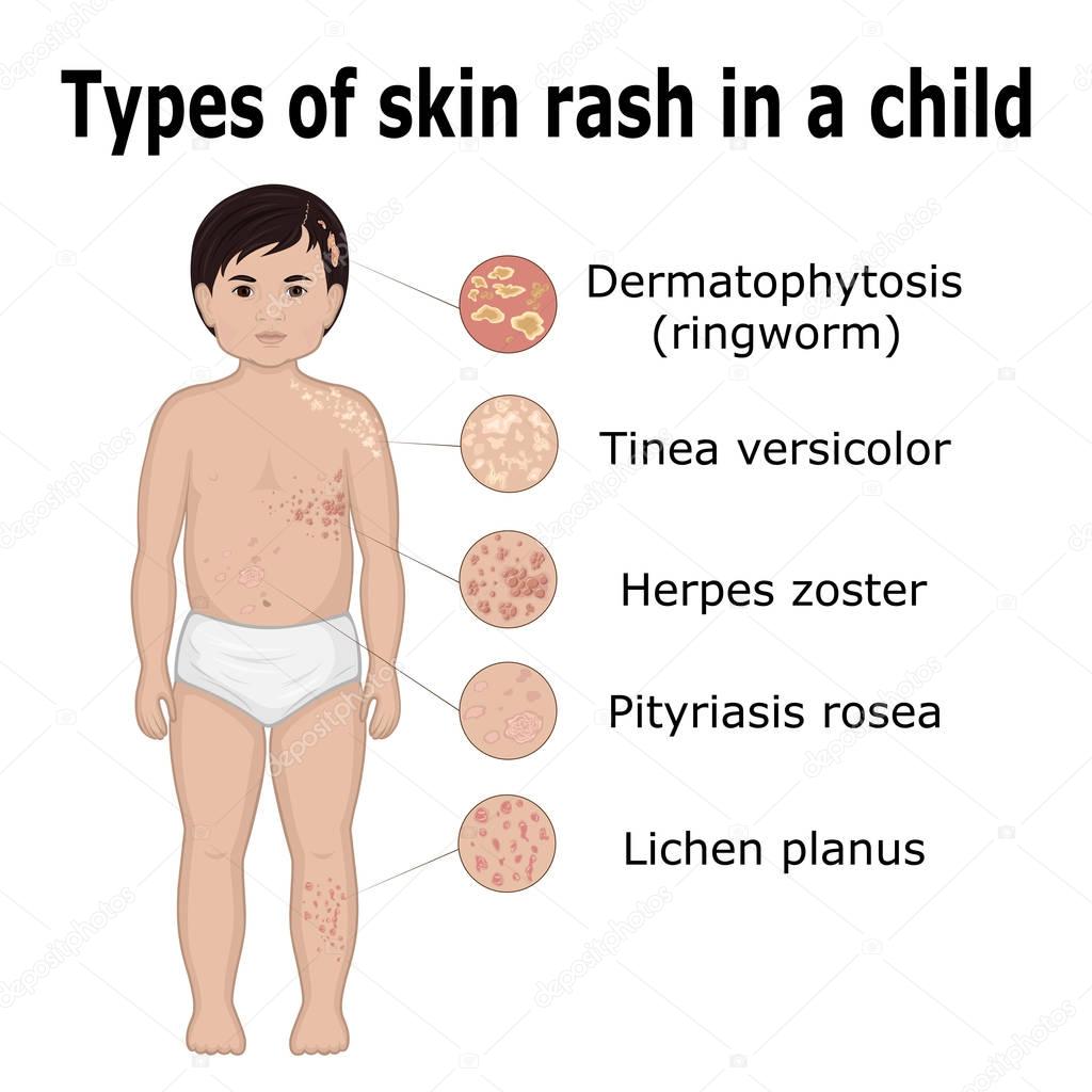 Five types of skin rashes on the body of a small child