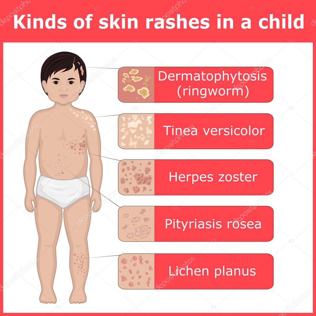 Five kinds of skin rashes on the body of a child