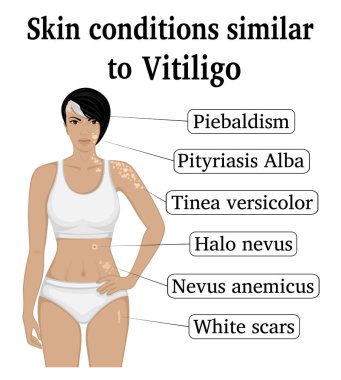 Altı farklı Vitiligo, Tinea versicolor, Pityriasis Alba, Piebaldism, beyaz izleri, Nevus anemicus ve Halo nevus gibi benzer cilt