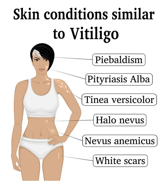 Six Different Skin Conditions Similar Vitiligo Tinea Versicolor Pityriasis Alba — Stock Vector