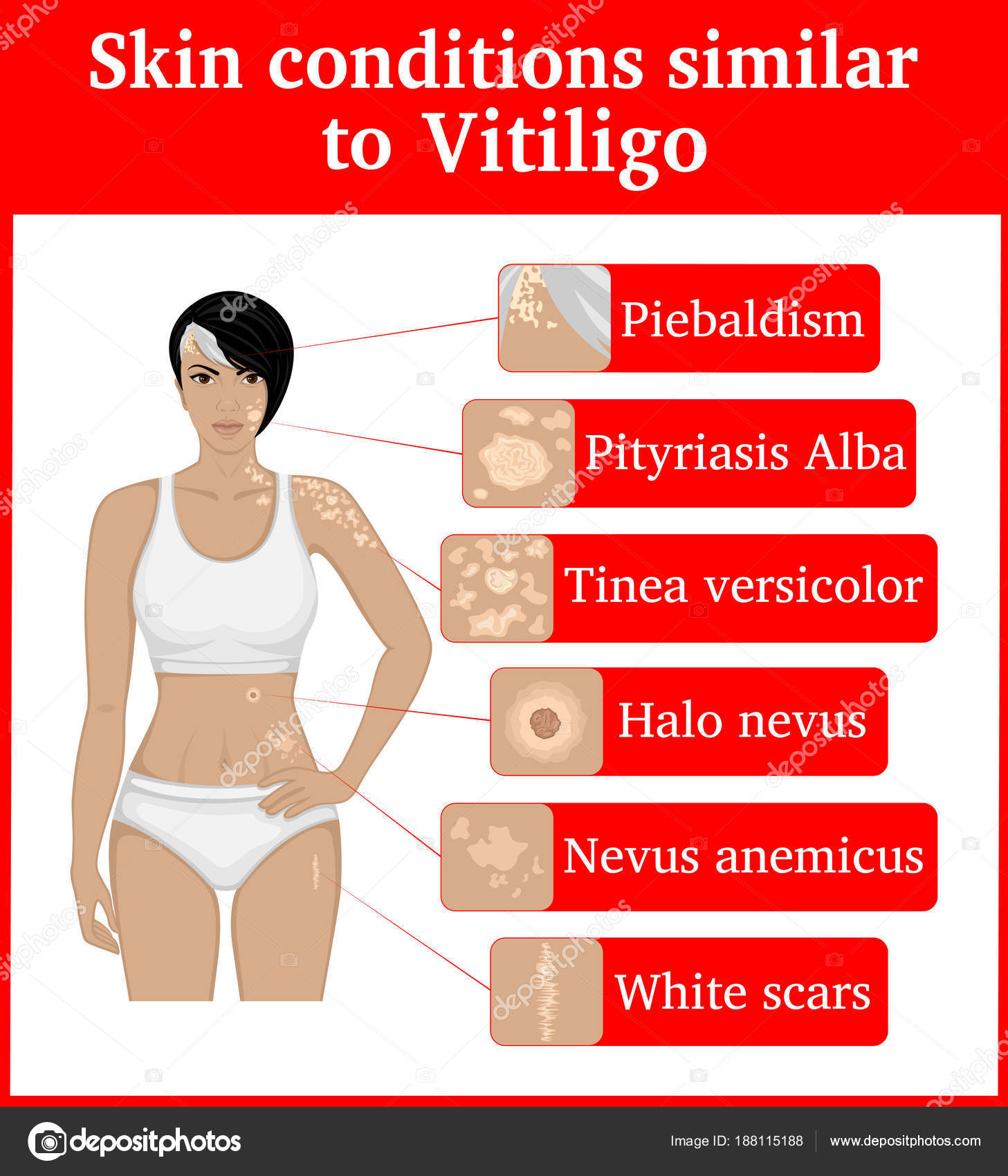 Six Skin Conditions Having External Similarity Vitiligo Vitiligo Tinea Versicolor ⬇ Vector Image by © scio21.ukr.net | Vector Stock 188115188 Six Skin Conditions Having External Similarity Vitiligo Vitiligo Tinea Versicolor ⬇ Vector Image by © scio21.ukr.net | Vector Stock 188115188