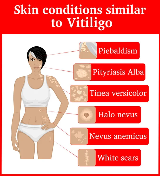 Six Skin Conditions Having External Similarity Vitiligo Vitiligo Tinea Versicolor — Stock Vector