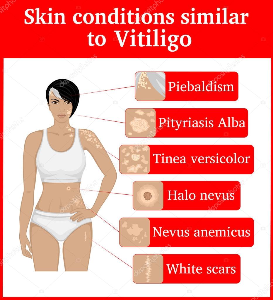 Six skin conditions having an external similarity with Vitiligo, such as Vitiligo, such as Tinea versicolor, Pityriasis Alba, Piebaldism, White scars, Nevus anemicus and Halo nevus