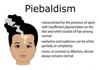 Piebaldism belirtileri olan küçük bir kızın illüstrasyon