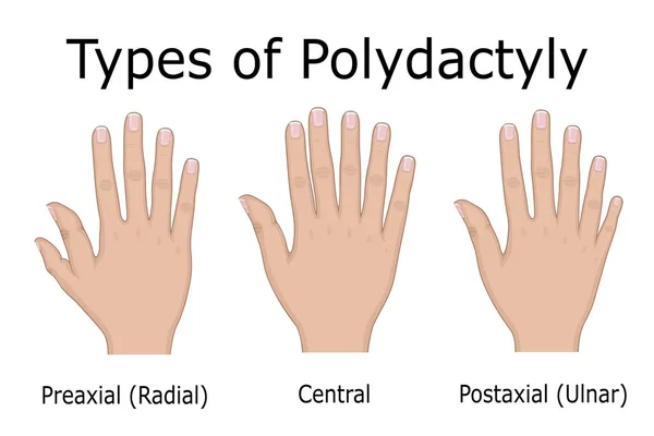 Ilustración Tres Tipos Polidactilia Como Preaxial Central Postaxial — Vector de stock