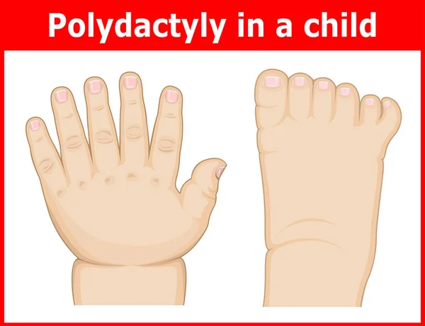 Illusztráció Polydactylia Láb Kéz Gyermek — Stock Vector