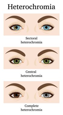 Heterokromi iridum tasviri