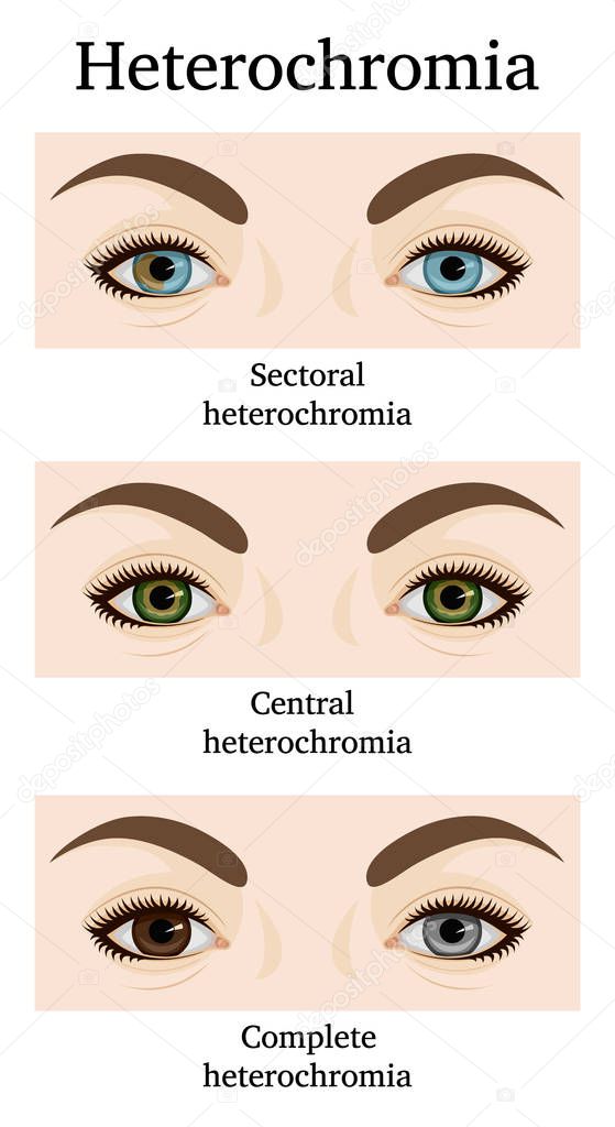 Illustration of Heterochromia iridum