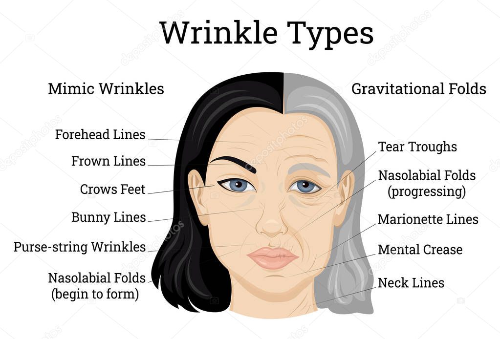 Illustration of two types of wrinkles, such as mimic and gravitational