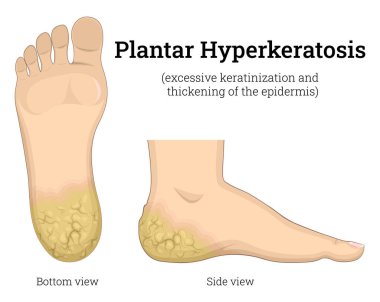 Illustration of dermatological diseases Plantar Hyperkeratosis clipart