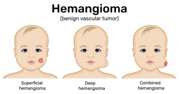 Ilustração Tumor Benigno Hemangioma Infantil —  Vetores de Stock