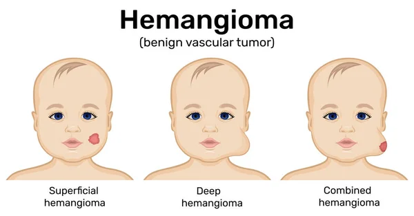 Illustrazione Tumore Benigno Dell Emangioma Infantile — Vettoriale Stock