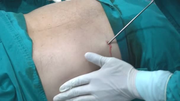 Doctor doing tumescent before do liposuction — Stock Video