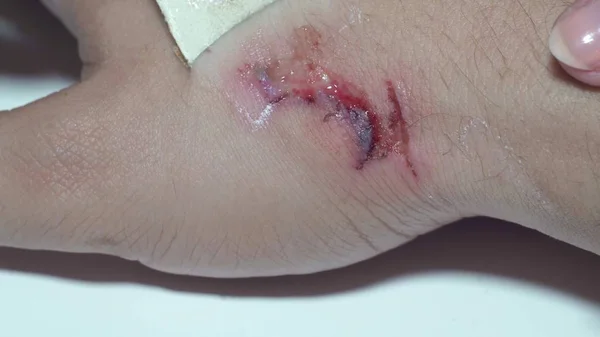 Лечение раны после укуса собаки, пореза руки, макро — стоковое фото