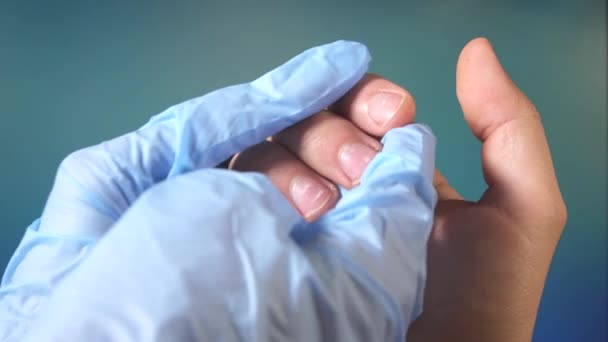 Witte vlekjes op de nagels van een mans handen — Stockvideo