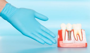 Diş implantlarının plastik örnekleri doğal dişlerle karşılaştırılır.