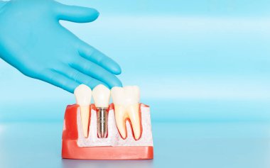 Diş implantlarının plastik örnekleri doğal dişlerle karşılaştırılır.