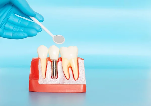 Amostras plásticas de implantes dentários se comparam com dentes naturais . — Fotografia de Stock