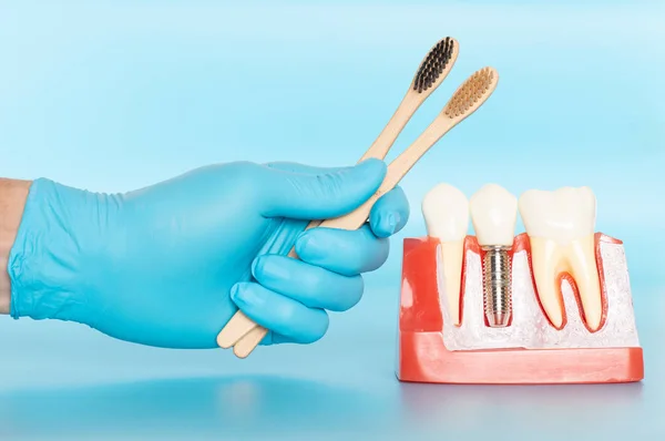 Las muestras plásticas de implantes dentales se comparan con dientes naturales . — Foto de Stock