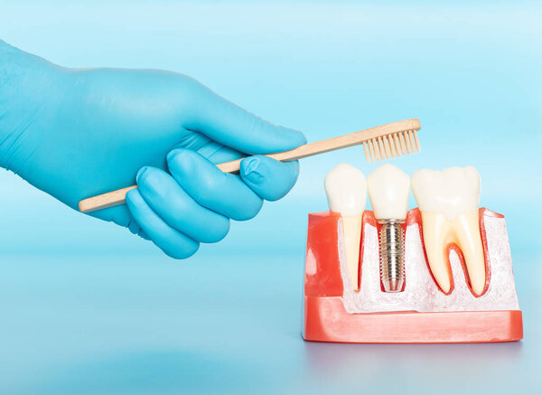 Plastic samples of dental implants compare with natural teeth.
