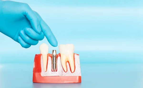 Las muestras plásticas de implantes dentales se comparan con dientes naturales . — Foto de Stock