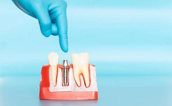 Plastic samples of dental implants compare with natural teeth.