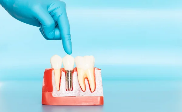 Diş implantlarının plastik örnekleri doğal dişlerle karşılaştırılır.