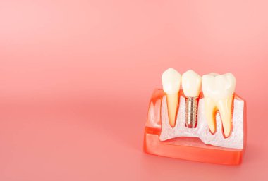 Açıklamada kullanılacak implantlar ve diş aletlerine örnek hastalara tedavi süreci hakkında bilgi verilsin.