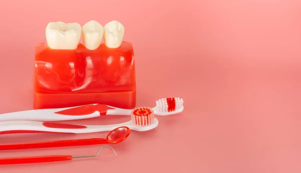 Ejemplo Implantes Herramientas Dentales Para Explicar Que Los Pacientes Sean — Foto de Stock