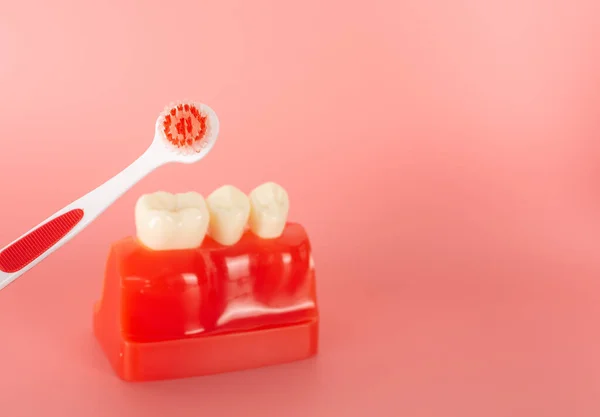 Ejemplo Implantes Herramientas Dentales Para Explicar Que Los Pacientes Sean — Foto de Stock