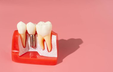 Diş implantlarından alınan örnekler diş implantlarının silikon bileşenlerini gösteriyor. Hastanın diş etlerine yerleştirildiğinde hastanın tedaviye başlamadan önce anlaması için..