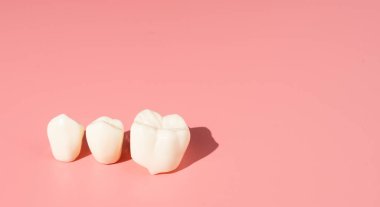 Diş implantlarından alınan örnekler diş implantlarının silikon bileşenlerini gösteriyor. Hastanın diş etlerine yerleştirildiğinde hastanın tedaviye başlamadan önce anlaması için..