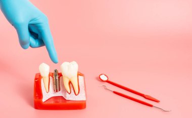 Diş implantlarından alınan örnekler diş implantlarının silikon bileşenlerini gösteriyor. Hastanın diş etlerine yerleştirildiğinde hastanın tedaviye başlamadan önce anlaması için..