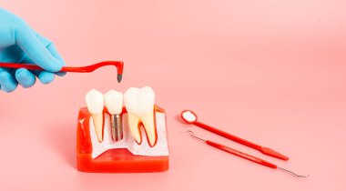 Diş implantlarından alınan örnekler diş implantlarının silikon bileşenlerini gösteriyor. Hastanın diş etlerine yerleştirildiğinde hastanın tedaviye başlamadan önce anlaması için..