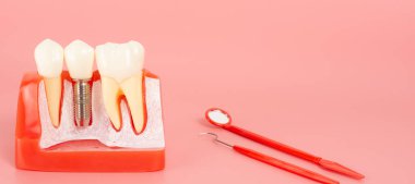 Diş implantlarından alınan örnekler diş implantlarının silikon bileşenlerini gösteriyor. Hastanın diş etlerine yerleştirildiğinde hastanın tedaviye başlamadan önce anlaması için..