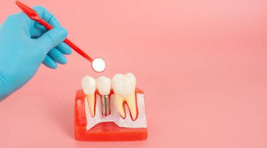 Diş implantlarından alınan örnekler diş implantlarının silikon bileşenlerini gösteriyor. Hastanın diş etlerine yerleştirildiğinde hastanın tedaviye başlamadan önce anlaması için..