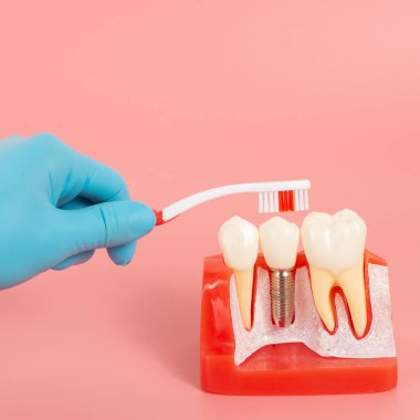 Diş implantlarından alınan örnekler diş implantlarının silikon bileşenlerini gösteriyor. Hastanın diş etlerine yerleştirildiğinde hastanın tedaviye başlamadan önce anlaması için..