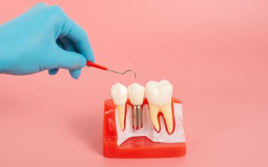 Diş implantlarından alınan örnekler diş implantlarının silikon bileşenlerini gösteriyor. Hastanın diş etlerine yerleştirildiğinde hastanın tedaviye başlamadan önce anlaması için..