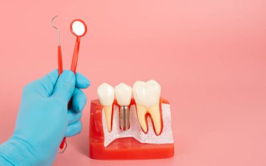 Diş implantlarından alınan örnekler diş implantlarının silikon bileşenlerini gösteriyor. Hastanın diş etlerine yerleştirildiğinde hastanın tedaviye başlamadan önce anlaması için..